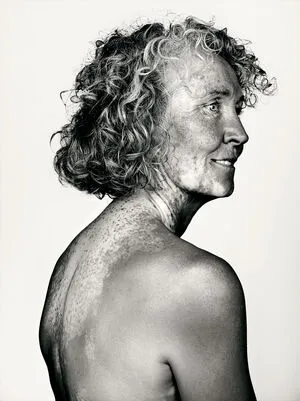 Vitiligo OnlyFans Leaked Free Thumbnail Picture - #1Ez25aZeCi