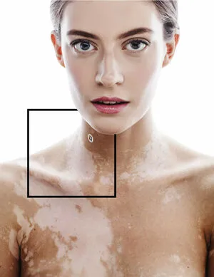 Vitiligo OnlyFans Leaked Free Thumbnail Picture - #6LvZLEfSHi