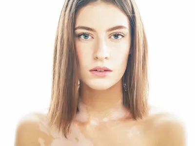 Vitiligo OnlyFans Leaked Free Thumbnail Picture - #Jy8L0FbVUK