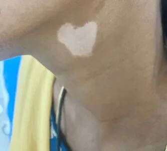 Vitiligo OnlyFans Leaked Free Thumbnail Picture - #ZHdejkZaE1
