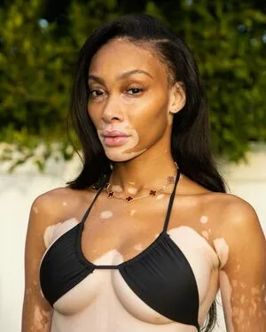 Winnie Harlow OnlyFans Leaked Free Thumbnail Picture - #1PP35S6npk