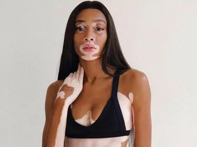 Winnie Harlow OnlyFans Leaked Free Thumbnail Picture - #2UYBqGZuXJ