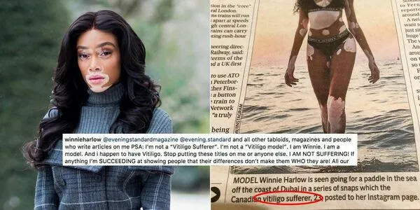 Winnie Harlow OnlyFans Leaked Free Thumbnail Picture - #3RdHptMoxD