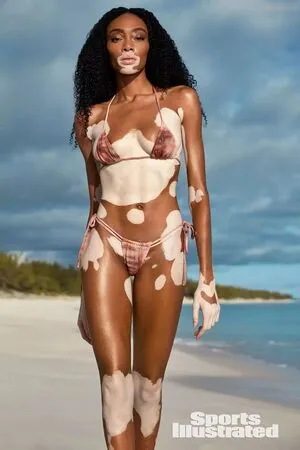 Winnie Harlow OnlyFans Leaked Free Thumbnail Picture - #5muART5cwN