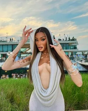Winnie Harlow OnlyFans Leaked Free Thumbnail Picture - #71byiqh7k8