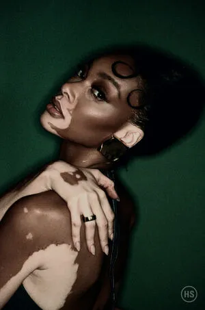 Winnie Harlow OnlyFans Leaked Free Thumbnail Picture - #8K17D2RRoX