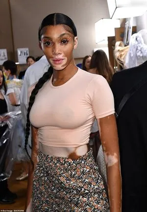 Winnie Harlow OnlyFans Leaked Free Thumbnail Picture - #8biQBBPhw9