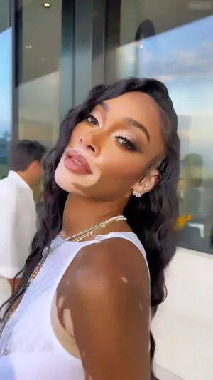 Winnie Harlow OnlyFans Leaked Free Thumbnail Picture - #AKO5fgo4nU