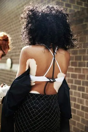 Winnie Harlow OnlyFans Leaked Free Thumbnail Picture - #Ef6Vq9XO6U