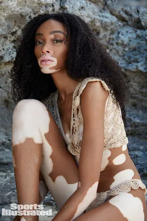 Winnie Harlow OnlyFans Leaked Free Thumbnail Picture - #Ew9JrWSp9Z