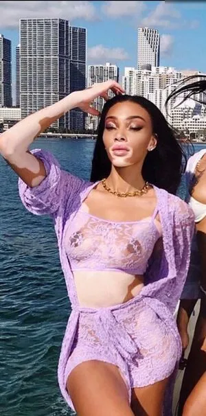 Winnie Harlow OnlyFans Leaked Free Thumbnail Picture - #KMst19ZSgZ