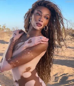 Winnie Harlow OnlyFans Leaked Free Thumbnail Picture - #KkI4i0saIF