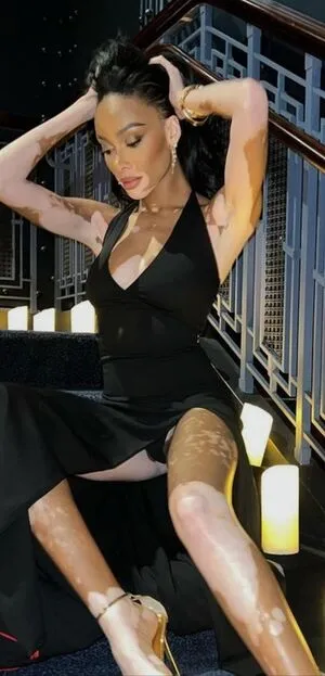 Winnie Harlow OnlyFans Leaked Free Thumbnail Picture - #PdHz8E81dQ