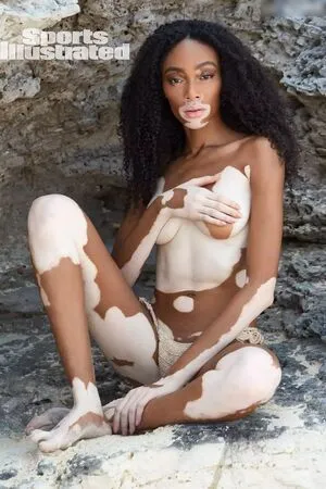 Winnie Harlow OnlyFans Leaked Free Thumbnail Picture - #RZtR9WzbEu