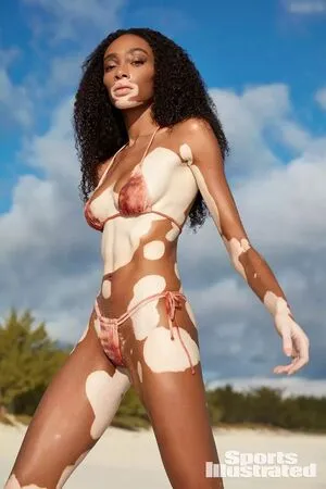 Winnie Harlow OnlyFans Leaked Free Thumbnail Picture - #SrG3Hv24M5