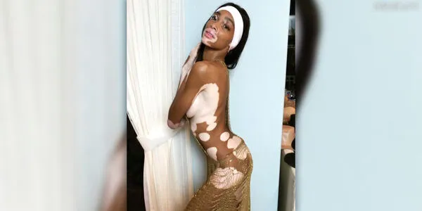 Winnie Harlow OnlyFans Leaked Free Thumbnail Picture - #UoewkAyGVE