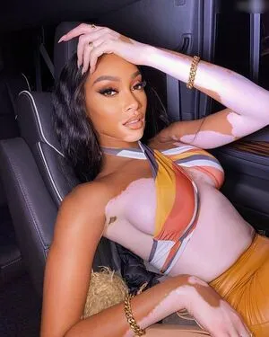 Winnie Harlow OnlyFans Leaked Free Thumbnail Picture - #Vyjkkaf0s5