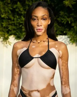Winnie Harlow OnlyFans Leaked Free Thumbnail Picture - #XAnI4rmqgv