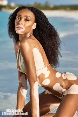 Winnie Harlow OnlyFans Leaked Free Thumbnail Picture - #awQ6VGcmmx