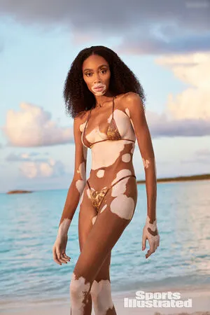 Winnie Harlow OnlyFans Leaked Free Thumbnail Picture - #dC7Tvn2u5Z