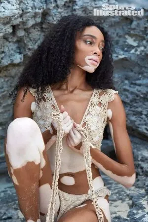 Winnie Harlow OnlyFans Leaked Free Thumbnail Picture - #h6JG8Ie5ou