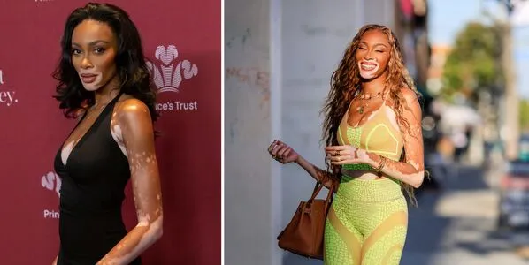 Winnie Harlow OnlyFans Leaked Free Thumbnail Picture - #otjncNTdjS