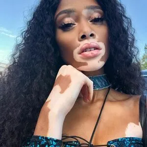 Winnie Harlow OnlyFans Leaked Free Thumbnail Picture - #r8PltuxOnW