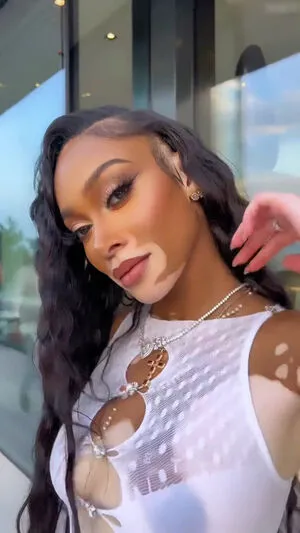 Winnie Harlow OnlyFans Leaked Free Thumbnail Picture - #t6Zb8TALYw